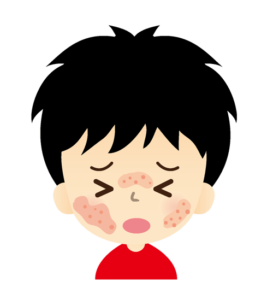 食物アレルギーの症状